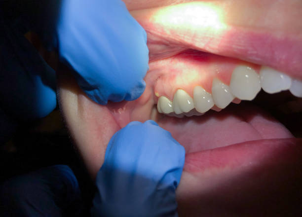 Best Broken or Cracked Tooth Emergency Dentist in Fort Meade, MD